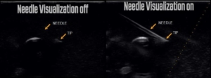 Needle Visualization ultrasound